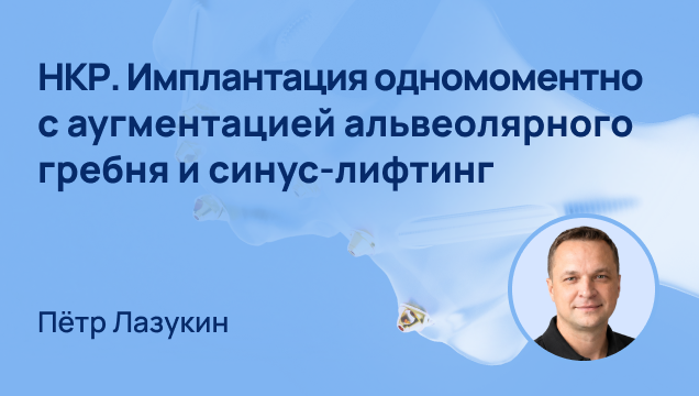 НКР. Имплантация одномоментно с аугментацией альвеолярного гребня и синус-лифтинг.